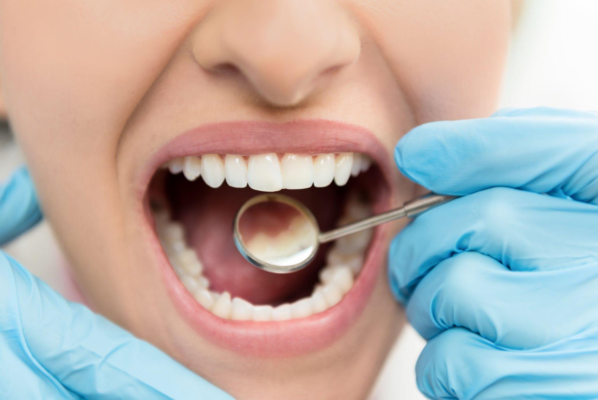 Symptoms of Tooth Enamel Erosions